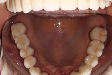 prosthetic bridges dental implant