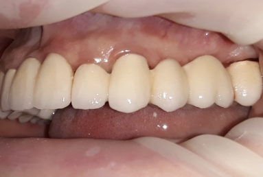 prosthetic bridges dental implant