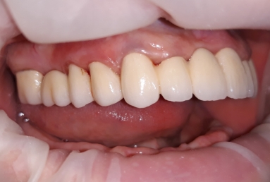 prosthetic bridges dental implant