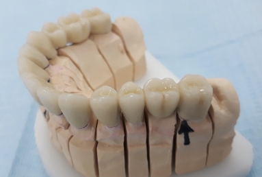 prosthetic bridges dental implant