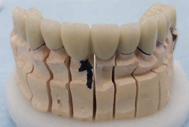 prosthetic bridges dental implant