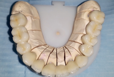 prosthetic bridges dental implant