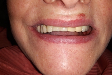 prosthetic bridges dental implant