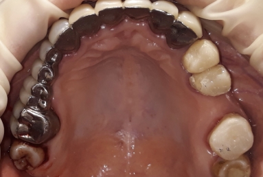 prosthetic bridges dental implant