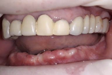 prosthetic bridges dental implant