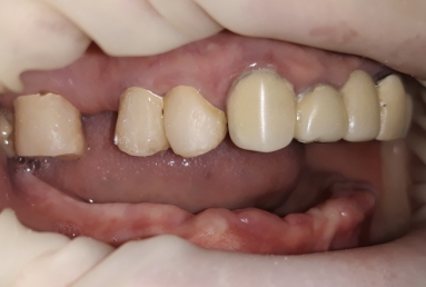 prosthetic bridges dental implant