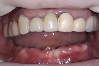 prosthetic bridges dental implant