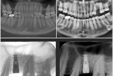 Orthodontic treatment