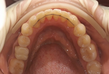 Orthodontic treatment