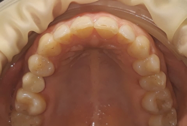 Orthodontic treatment