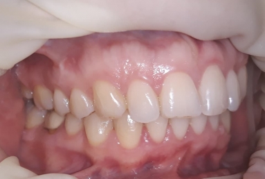 Orthodontic treatment