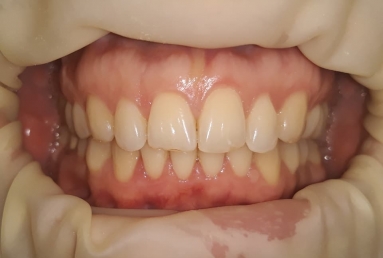 Orthodontic treatment