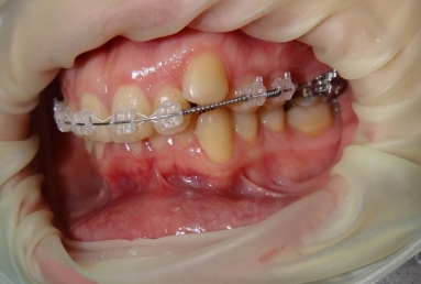 Orthodontic treatment