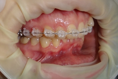 Orthodontic treatment