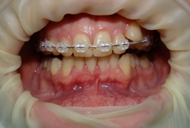 Orthodontic treatment