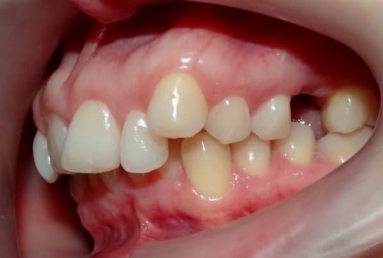 Orthodontic treatment