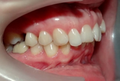 Orthodontic treatment