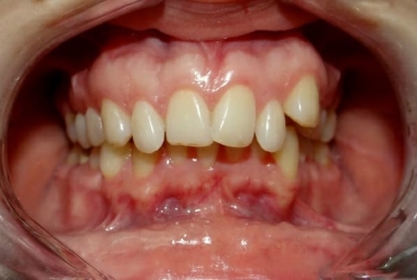 Orthodontic treatment