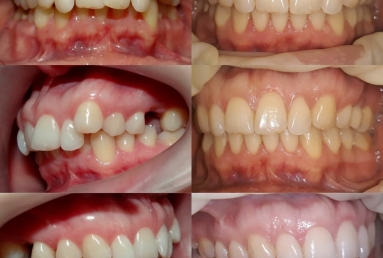 Orthodontic treatment