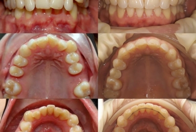 Orthodontic treatment