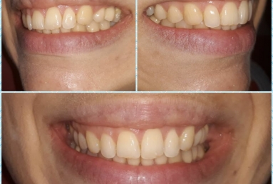 Orthodontic treatment