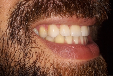 Porcelain veneers