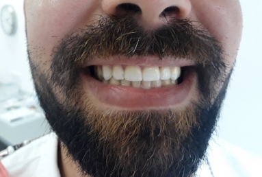 Porcelain veneers