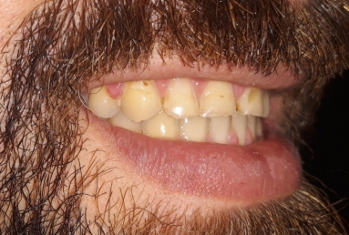 Porcelain veneers