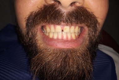 Porcelain veneers