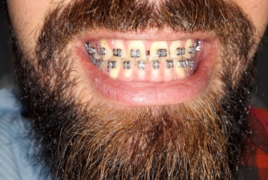 Porcelain veneers