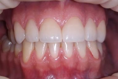 Porcelain veneers