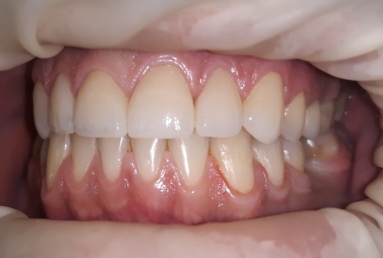 Porcelain veneers
