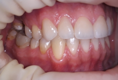 Porcelain veneers