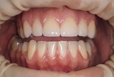 Porcelain veneers