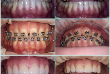 Porcelain veneers