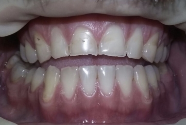 Porcelain veneers