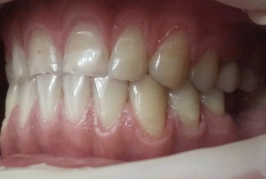 Porcelain veneers
