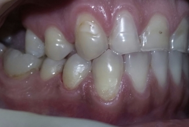 Porcelain veneers
