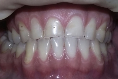 Porcelain veneers