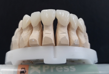 Porcelain veneers