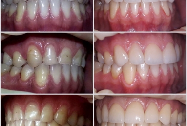 Porcelain veneers