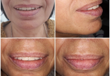 Mobile Prosthesis fixed with 4 locators