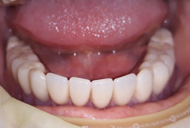 Mobile Prosthesis with Alpha BIO Nobel dental implants