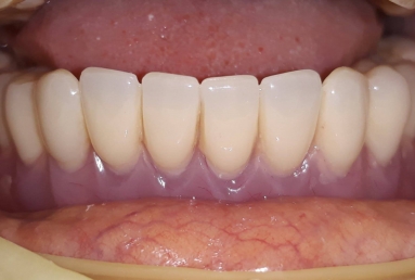 Mobile Prosthesis with Alpha BIO Nobel dental implants