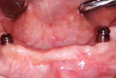 Mobile Prosthesis with Alpha BIO Nobel dental implants