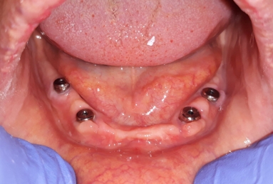 Mobile Prosthesis with Alpha BIO Nobel dental implants