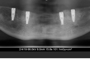 Mobile Prosthesis with Alpha BIO Nobel dental implants