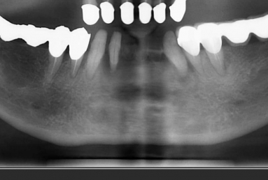 Mobile Prosthesis with Alpha BIO Nobel dental implants