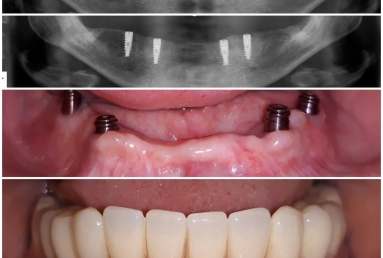 Mobile Prosthesis with Alpha BIO Nobel dental implants