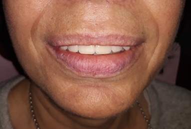 dental implant Mobile Prosthesis